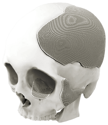 Implant crânien