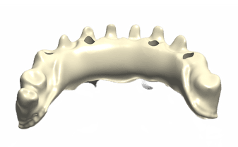 Prothèse implantaire