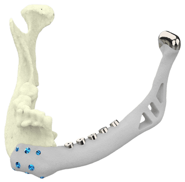 Implant mandibulaire
